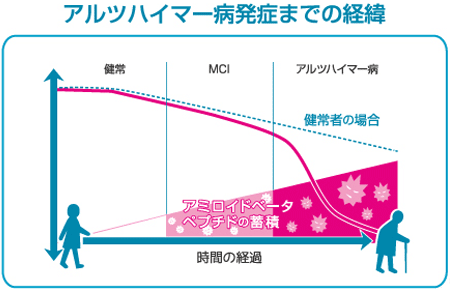 アルツハイマー病発症までの経緯